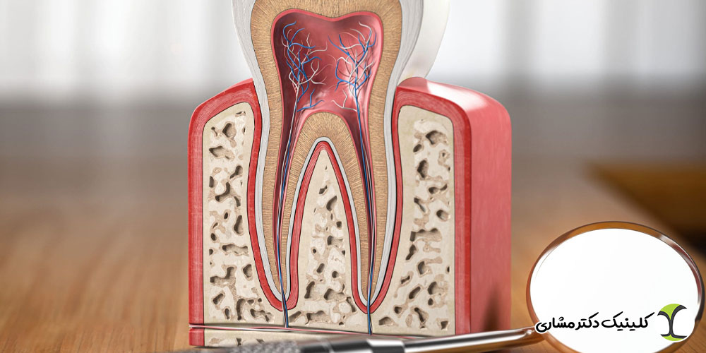 علائم نیاز به درمان ریشه دندان