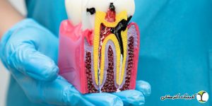 علائم نیاز به درمان ریشه دندان