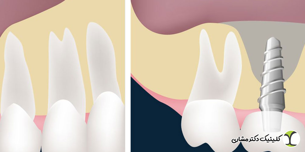 تفاوت سینوس لیفت و پیوند استخوان