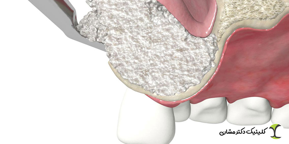 تفاوت سینوس لیفت و پیوند استخوان