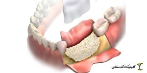 تفاوت سینوس لیفت و پیوند استخوان