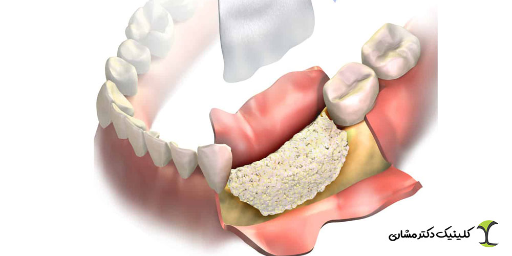 تفاوت سینوس لیفت و پیوند استخوان