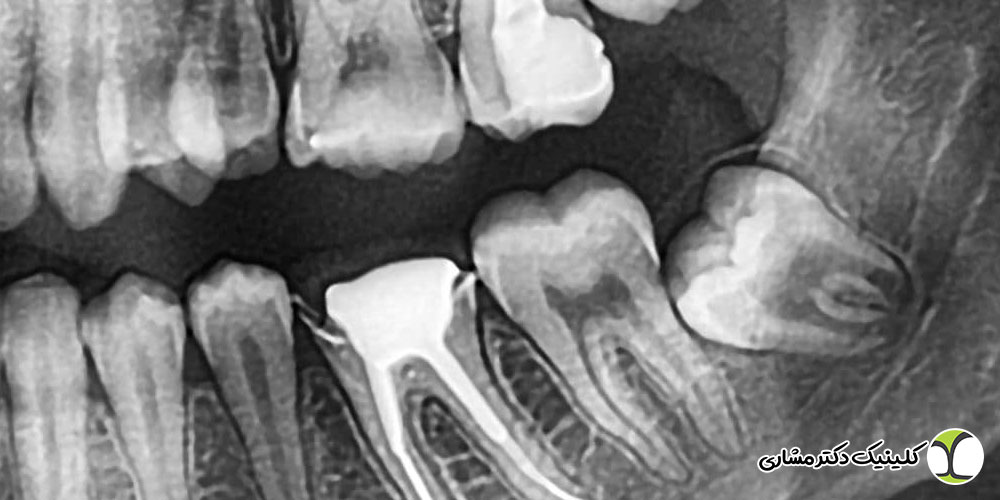درمان ریشه دندان عقل