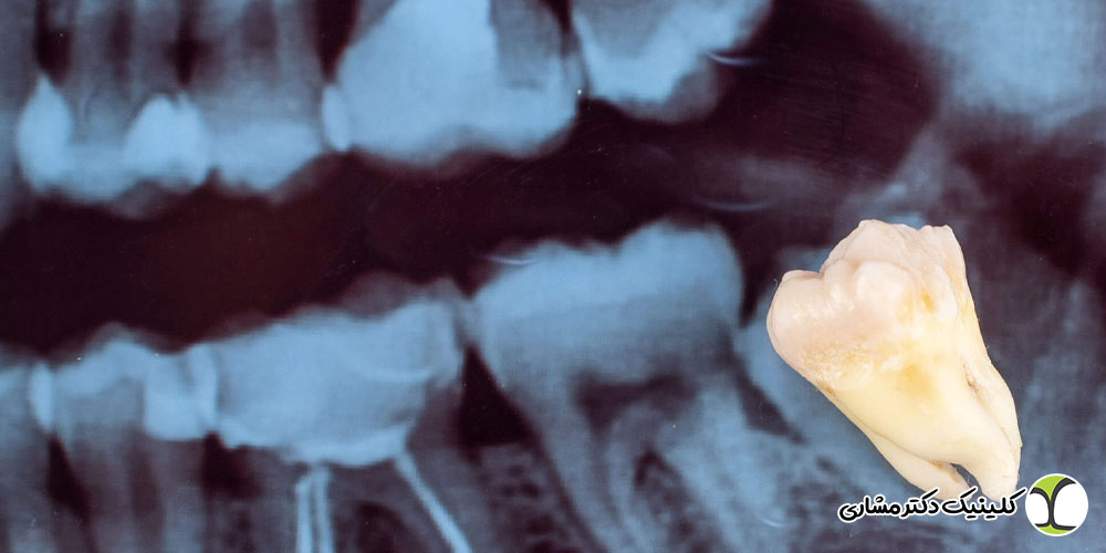 درمان ریشه دندان عقل