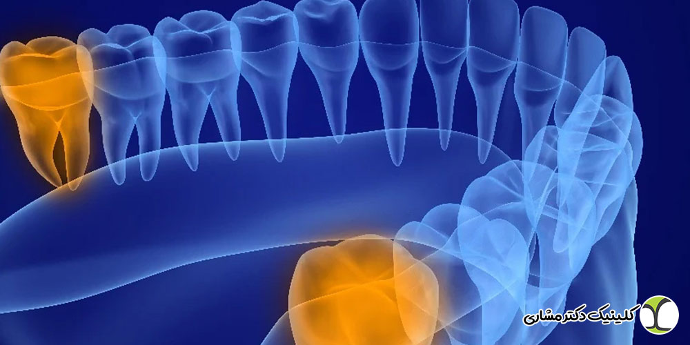 درمان ریشه دندان عقل