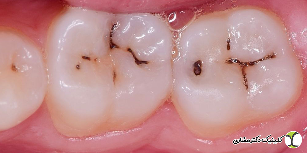 مرگ دندان چیست