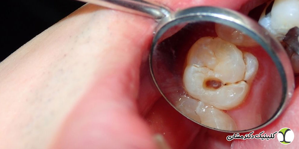 مرگ دندان چیست