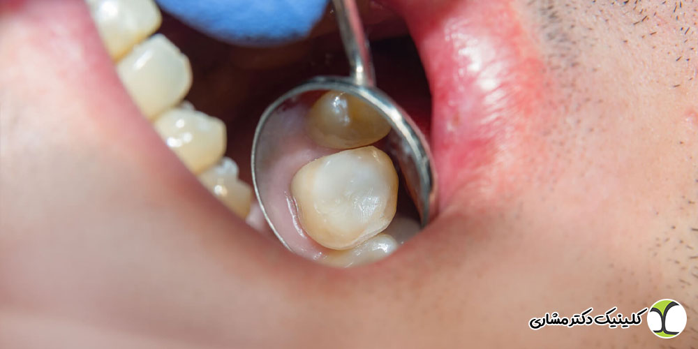 آیا برای عصبکشی باید لمینتها خارج شوند