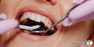 آیا برای عصبکشی باید لمینتها خارج شوند