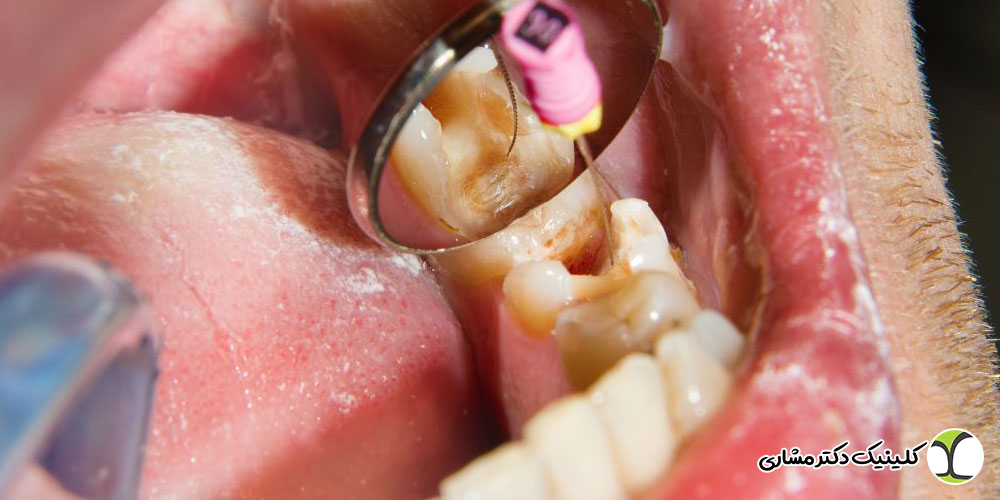 مصرف آنتی بیوتیک بعد از درمان ریشه
