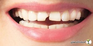 علت شکستن دندان چیست