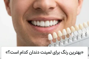 بهترین رنگ برای لمینت دندان- تصویری از لبخند فردی که لمینت دندان انجام داده وکاتالوگ رنگ لمینت در کنار او
