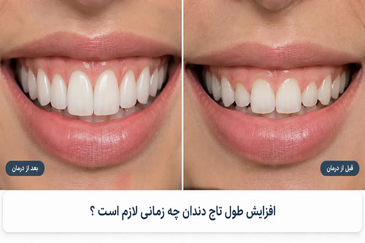 تصویری از قبل و بعد از درمان افزایش طول تاج دندان